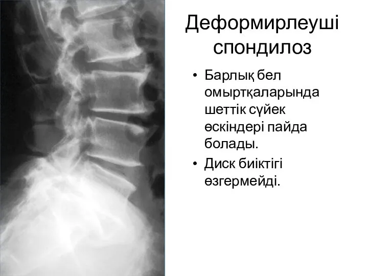 Деформирлеуші спондилоз Барлық бел омыртқаларында шеттік сүйек өскіндері пайда болады. Диск биіктігі өзгермейді.