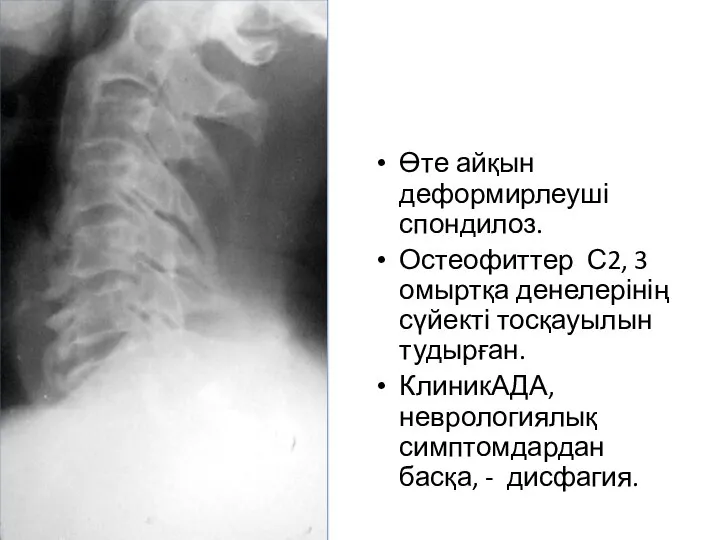 Өте айқын деформирлеуші спондилоз. Остеофиттер С2, 3 омыртқа денелерінің сүйекті тосқауылын тудырған.