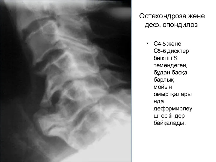 Остехондроза және деф. спондилоз С4-5 және С5-6 дисктер биіктігі ½ төмендеген, бұдан