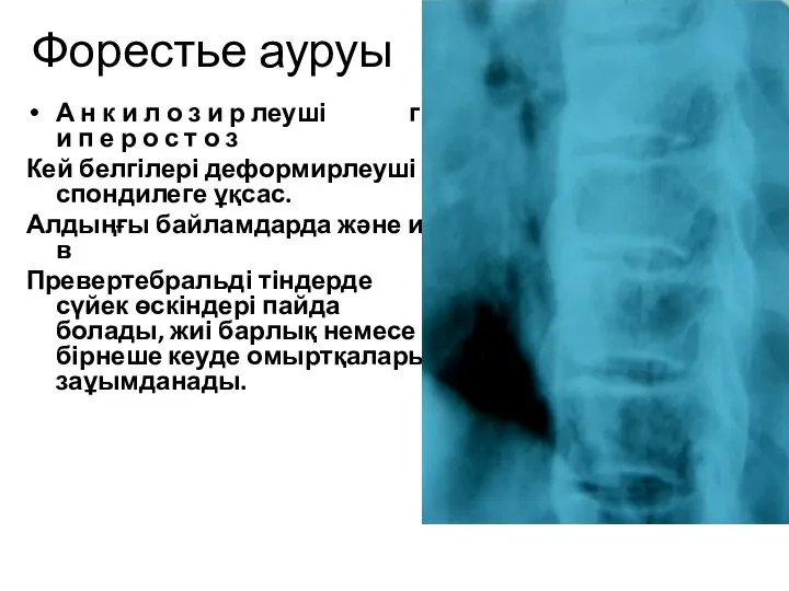 Форестье ауруы А н к и л о з и р леуші