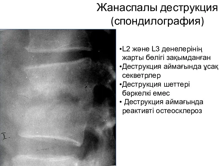 Жанаспалы деструкция (спондилография) L2 және L3 денелерінің жарты бөлігі зақымданған Деструкция аймағында