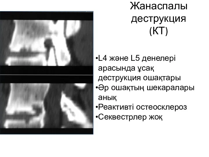 Жанаспалы деструкция (КТ) L4 және L5 денелері арасында ұсақ деструкция ошақтары Әр