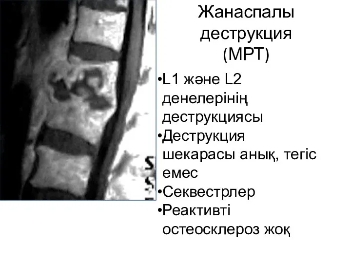 Жанаспалы деструкция (МРТ) L1 және L2 денелерінің деструкциясы Деструкция шекарасы анық, тегіс