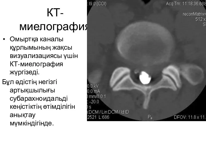 КТ-миелография Омыртқа каналы құрлымының жақсы визуализациясы үшін КТ-миелография жүргізеді. Бұл әдістің негізгі