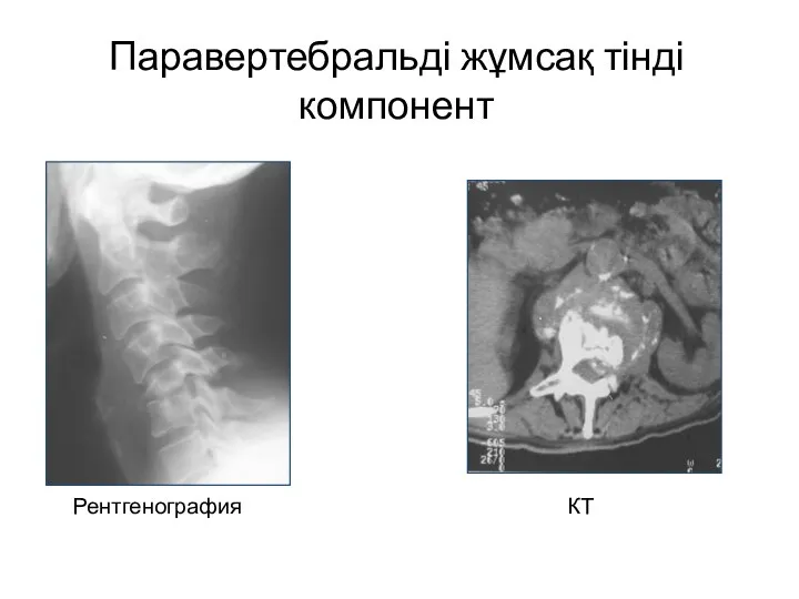 Паравертебральді жұмсақ тінді компонент Рентгенография КТ
