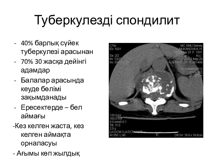 Туберкулезді спондилит 40% барлық сүйек туберкулезі арасынан 70% 30 жасқа дейінгі адамдар