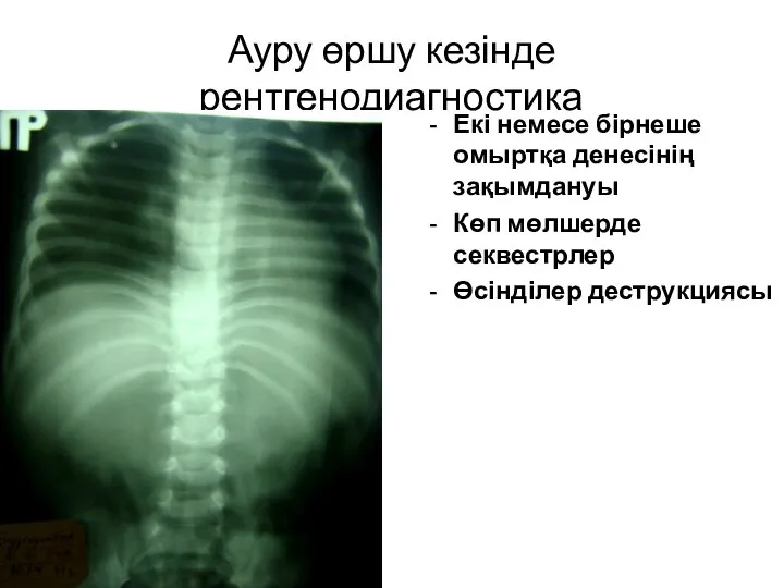 Ауру өршу кезінде рентгенодиагностика Екі немесе бірнеше омыртқа денесінің зақымдануы Көп мөлшерде секвестрлер Өсінділер деструкциясы