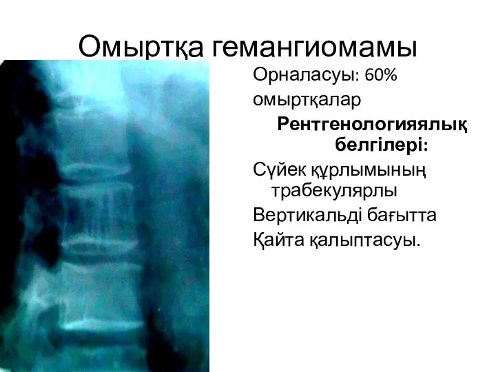 Омыртқа гемангиомамы Орналасуы: 60% омыртқалар Рентгенологияялық белгілері: Сүйек құрлымының трабекулярлы Вертикальді бағытта Қайта қалыптасуы.