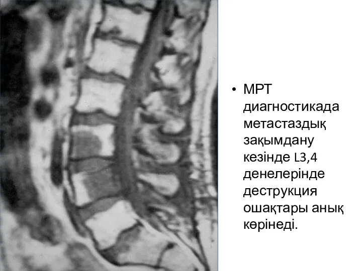 МРТ диагностикада метастаздық зақымдану кезінде L3,4 денелерінде деструкция ошақтары анық көрінеді.