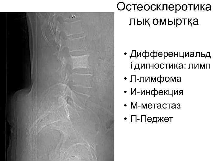 Остеосклеротикалық омыртқа Дифференциальді дигностика: лимп Л-лимфома И-инфекция М-метастаз П-Педжет