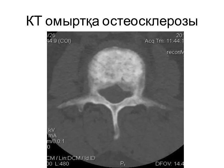 КТ омыртқа остеосклерозы