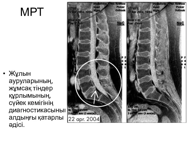 МРТ Жұлын ауруларының, жұмсақ тіндер құрлымының, сүйек кемігінің диагностикасының алдыңғы қатарлы әдісі.