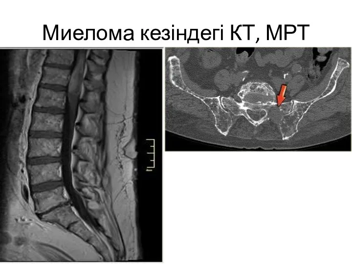 Миелома кезіндегі КТ, МРТ