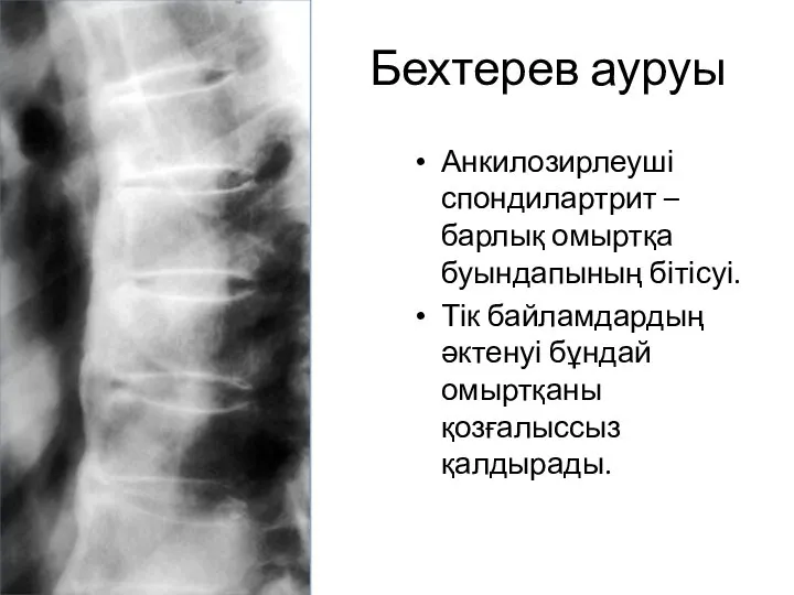 Бехтерев ауруы Анкилозирлеуші спондилартрит –барлық омыртқа буындапының бітісуі. Тік байламдардың әктенуі бұндай омыртқаны қозғалыссыз қалдырады.