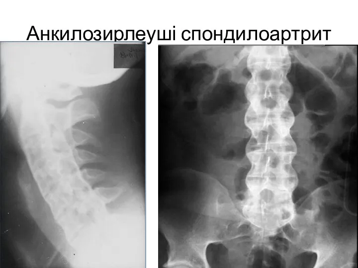 Анкилозирлеуші спондилоартрит