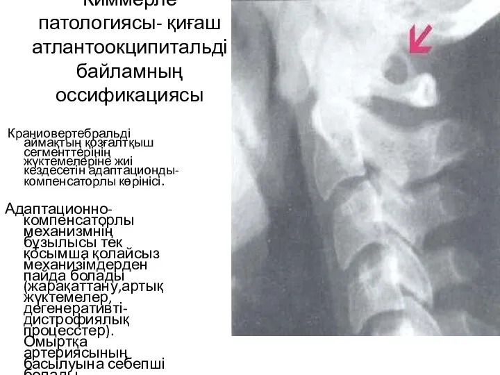 Киммерле патологиясы- қиғаш атлантоокципитальді байламның оссификациясы Краниовертебральді аймақтың қозғалтқыш сегменттерінің жүктемелеріне жиі