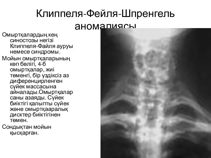 Клиппеля-Фейля-Шпренгель аномалиясы Омыртқалардың кең синостозы негізі Клиппеля-Файля ауруы немесе синдромы. Мойын омыртқаларының