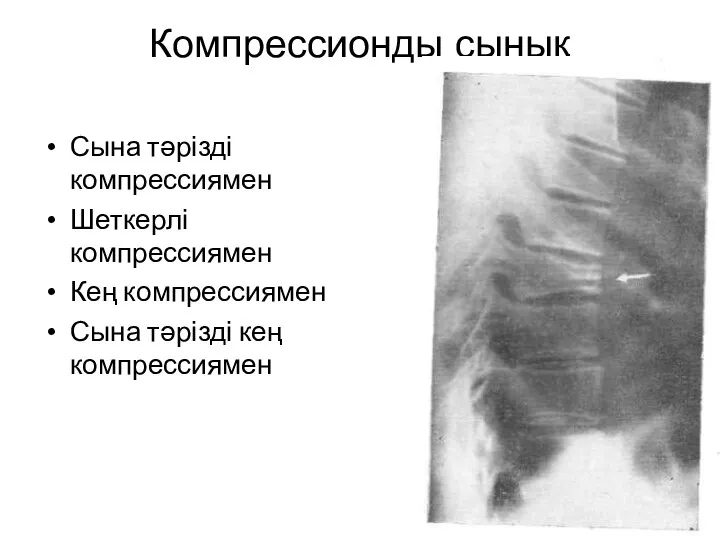 Компрессионды сынық Сына тәрізді компрессиямен Шеткерлі компрессиямен Кең компрессиямен Сына тәрізді кең компрессиямен