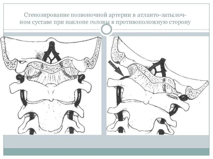 Стенозирование позвоночной артерии в атланто-затылоч- ном суставе при наклоне головы в противоположную сторону