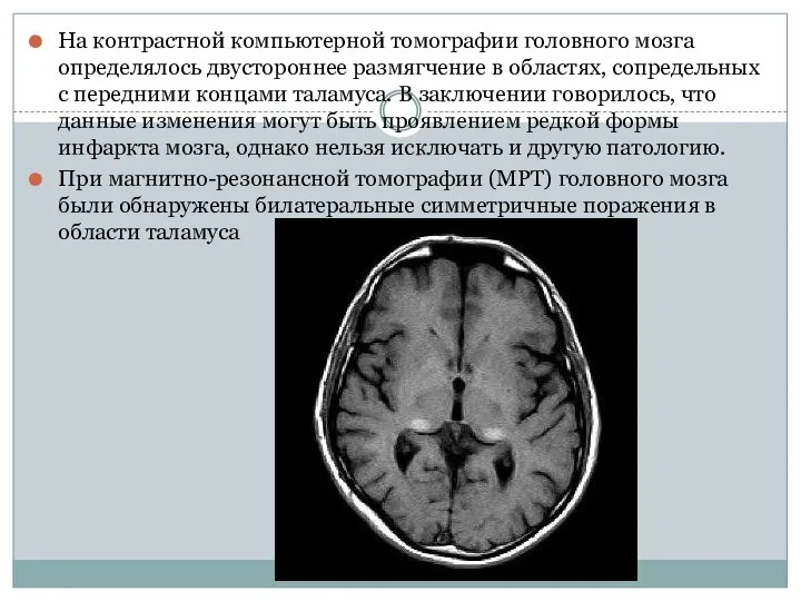 На контрастной компьютерной томографии головного мозга определялось двустороннее размягчение в областях, сопредельных