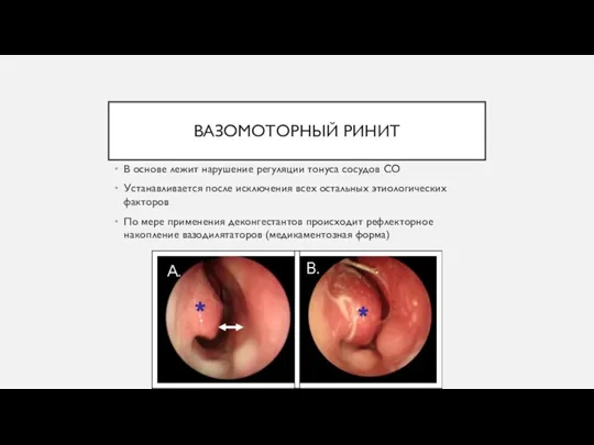 ВАЗОМОТОРНЫЙ РИНИТ В основе лежит нарушение регуляции тонуса сосудов СО Устанавливается после