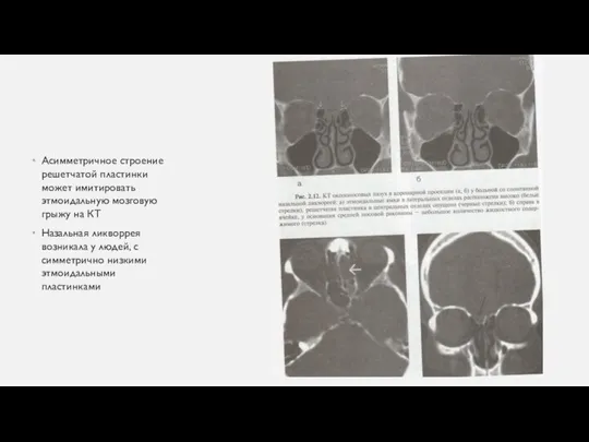 Асимметричное строение решетчатой пластинки может имитировать этмоидальную мозговую грыжу на КТ Назальная