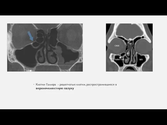 Клетки Галлера - решетчатые клетки, распространившиеся в верхнечелюстную пазуху