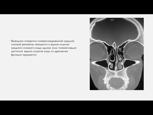 Выводное отверстие пневматизированной средней носовой раковины находится в задних отделах среднего носового