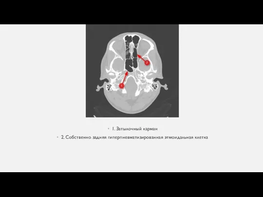 1. Затылочный карман 2. Собственно задняя гиперпневматизированная этмоидальная клетка