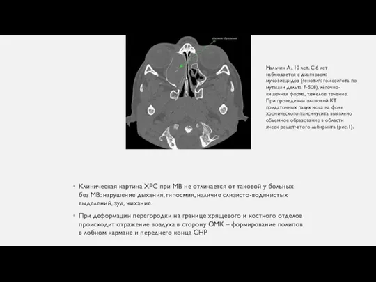 Клиническая картина ХРС при МВ не отличается от таковой у больных без