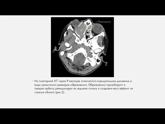 На повторной КТ через 9 месяцев отмечается отрицательная динамика в виде увеличения
