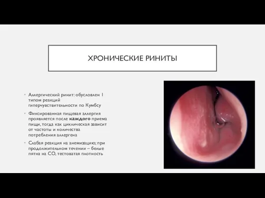ХРОНИЧЕСКИЕ РИНИТЫ Аллергический ринит: обусловлен 1 типом реакций гиперчувствительности по Кумбсу Фиксированная