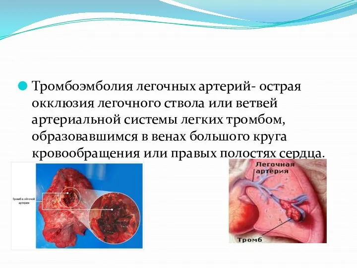 Тромбоэмболия легочных артерий- острая окклюзия легочного ствола или ветвей артериальной системы легких