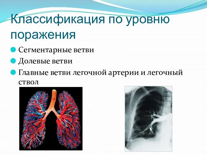 Классификация по уровню поражения Сегментарные ветви Долевые ветви Главные ветви легочной артерии и легочный ствол