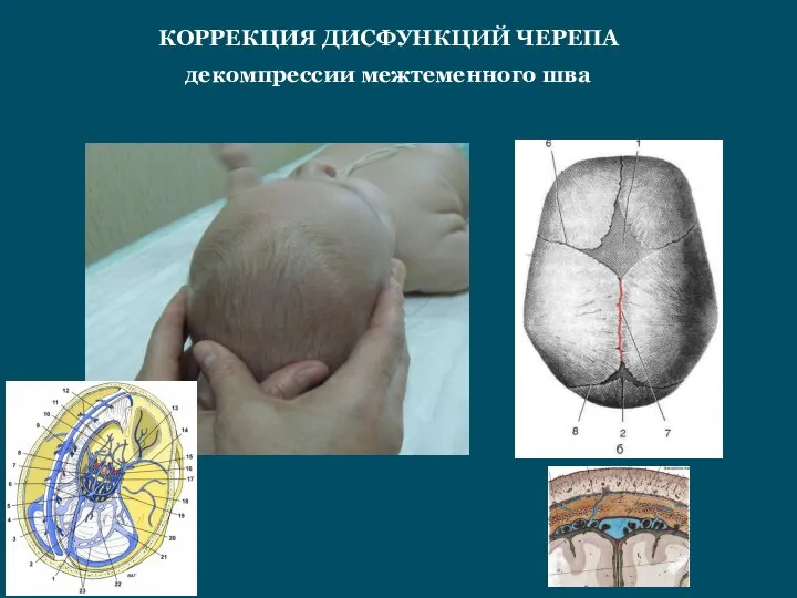 КОРРЕКЦИЯ ДИСФУНКЦИЙ ЧЕРЕПА декомпрессии межтеменного шва