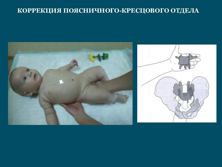 КОРРЕКЦИЯ ПОЯСНИЧНОГО-КРЕСЦОВОГО ОТДЕЛА