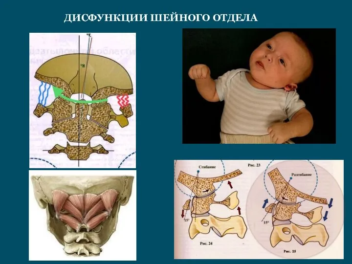 ДИСФУНКЦИИ ШЕЙНОГО ОТДЕЛА