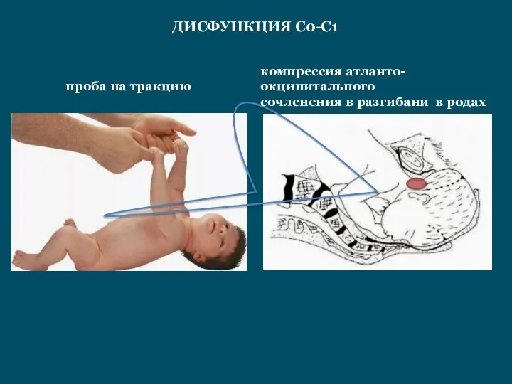 проба на тракцию ДИСФУНКЦИЯ С0-С1 компрессия атланто-окципитального сочленения в разгибани в родах