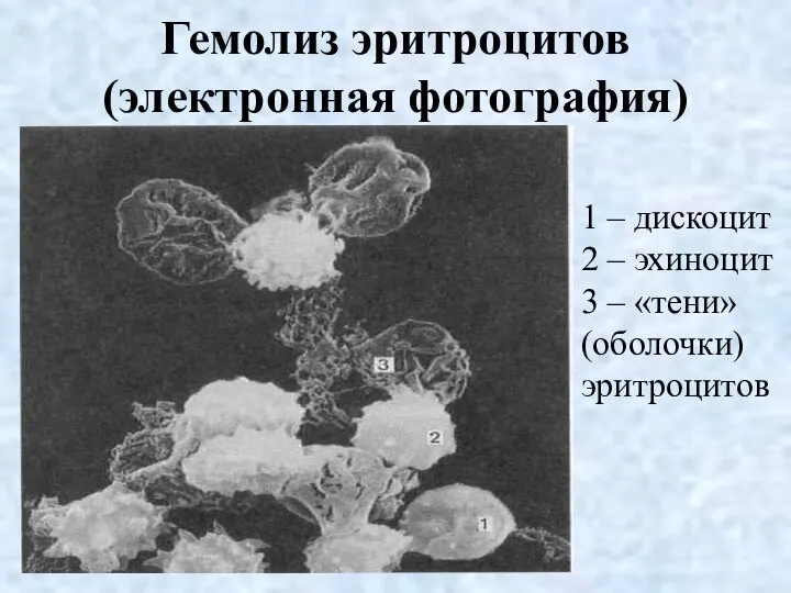 Гемолиз эритроцитов (электронная фотография) 1 – дискоцит 2 – эхиноцит 3 – «тени» (оболочки) эритроцитов