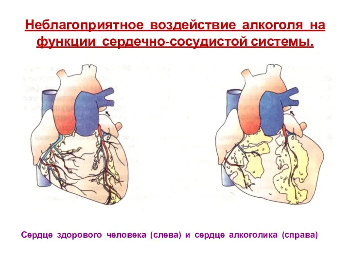 Неблагоприятное воздействие алкоголя на функции сердечно-сосудистой системы. Сердце здорового человека (слева) и сердце алкоголика (справа)