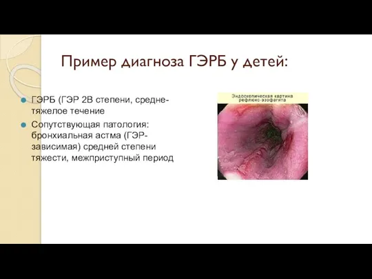 Пример диагноза ГЭРБ у детей: ГЭРБ (ГЭР 2В степени, средне-тяжелое течение Сопутствующая