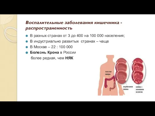 Воспалительные заболевания кишечника - распространенность В разных странах от 3 до 400