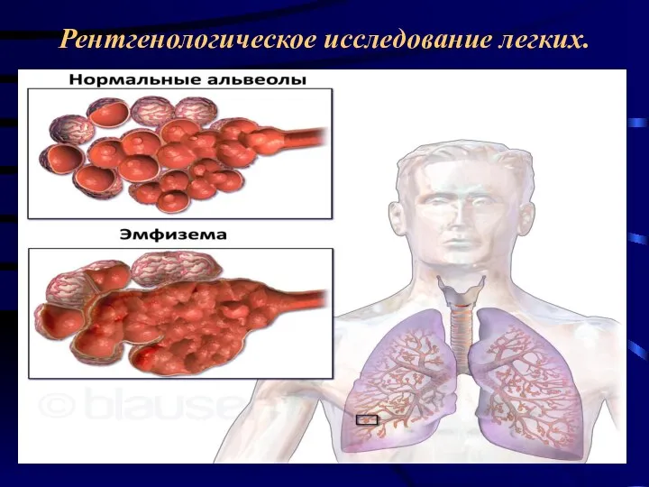 Рентгенологическое исследование легких.