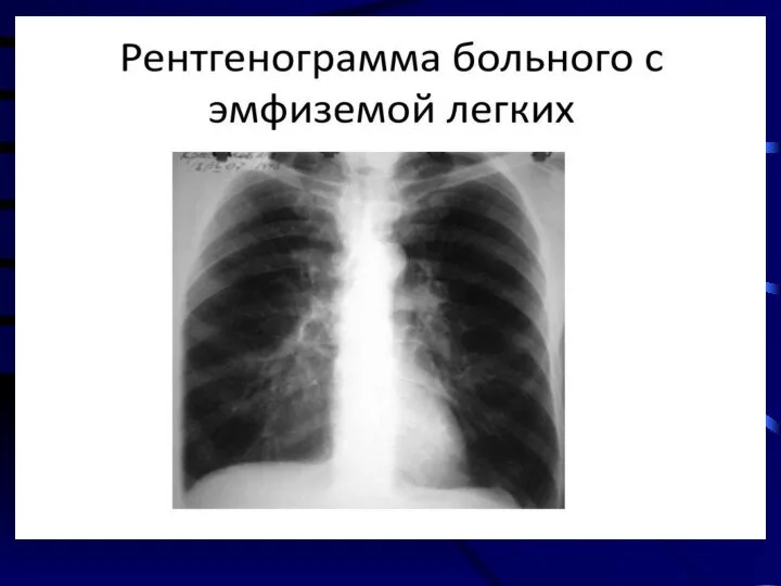 Рентгенологическое исследование легких.