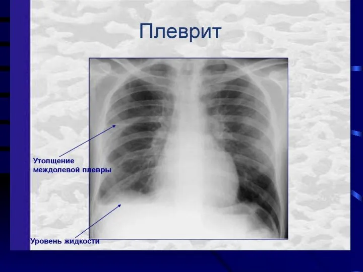 Инструментальная диагностика синдрома скопления жидкости в плевральной полости. -