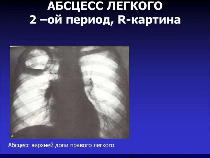 Инструментальные исследования. Рентгенограмма грудной клетки: - до прорыва абсцесса в бронх –