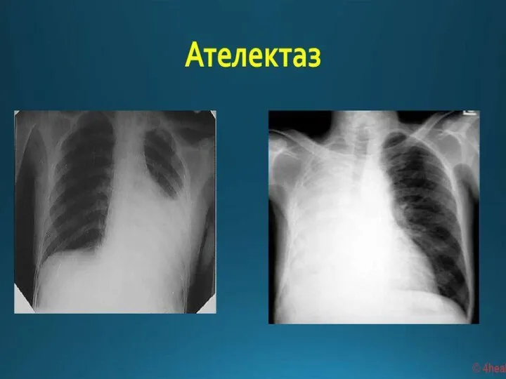 Клиника и диагностика компрессионного ателектаза легкого. Пальпация грудной клетки: ригидность межреберных промежутков,