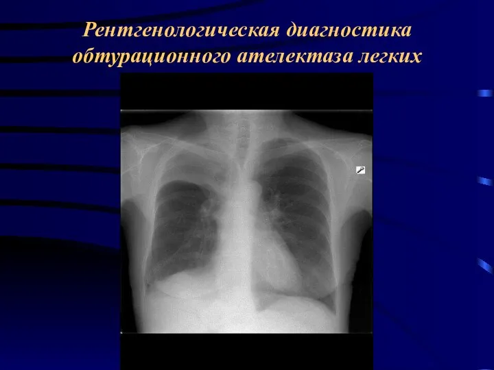 Рентгенологическая диагностика обтурационного ателектаза легких