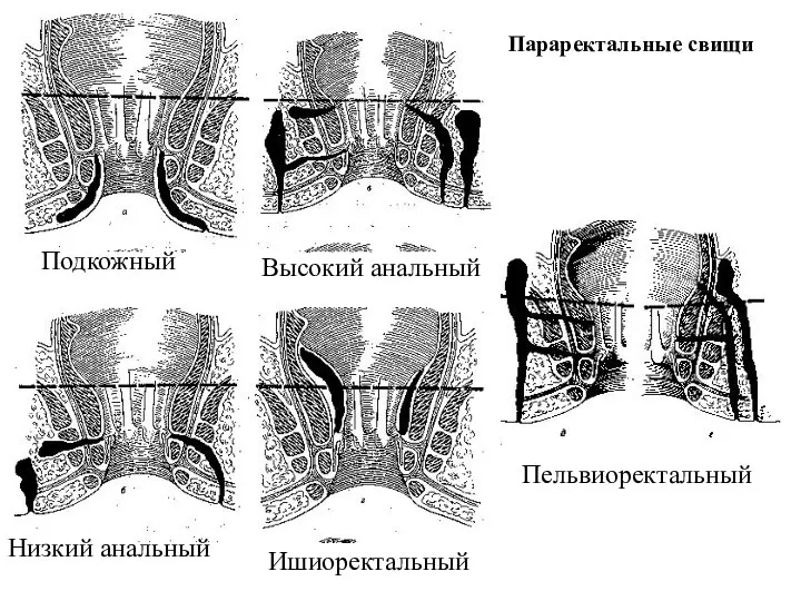 Параректальные свищи Подкожный Высокий анальный Низкий анальный Ишиоректальный Пельвиоректальный