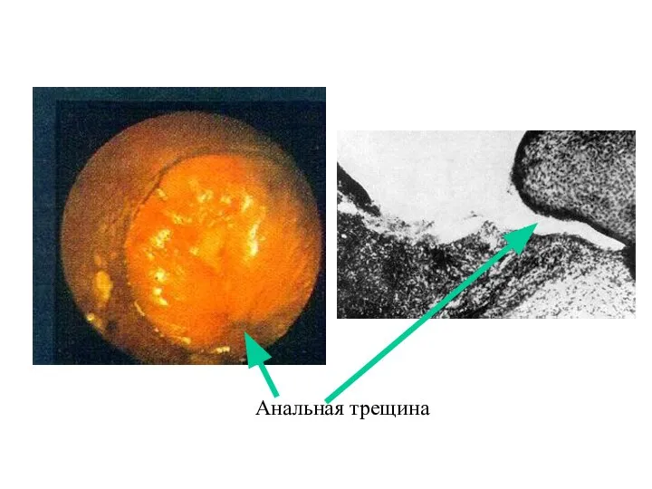 Анальная трещина